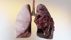 Comparison of a healthy lung and a diseased lung affected by smoking or lung cancer 